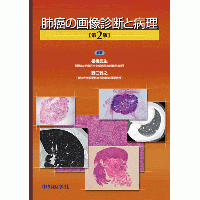 肺癌の画像診断と病理