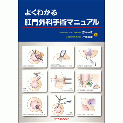 よくわかる肛門外科手術マニュアル